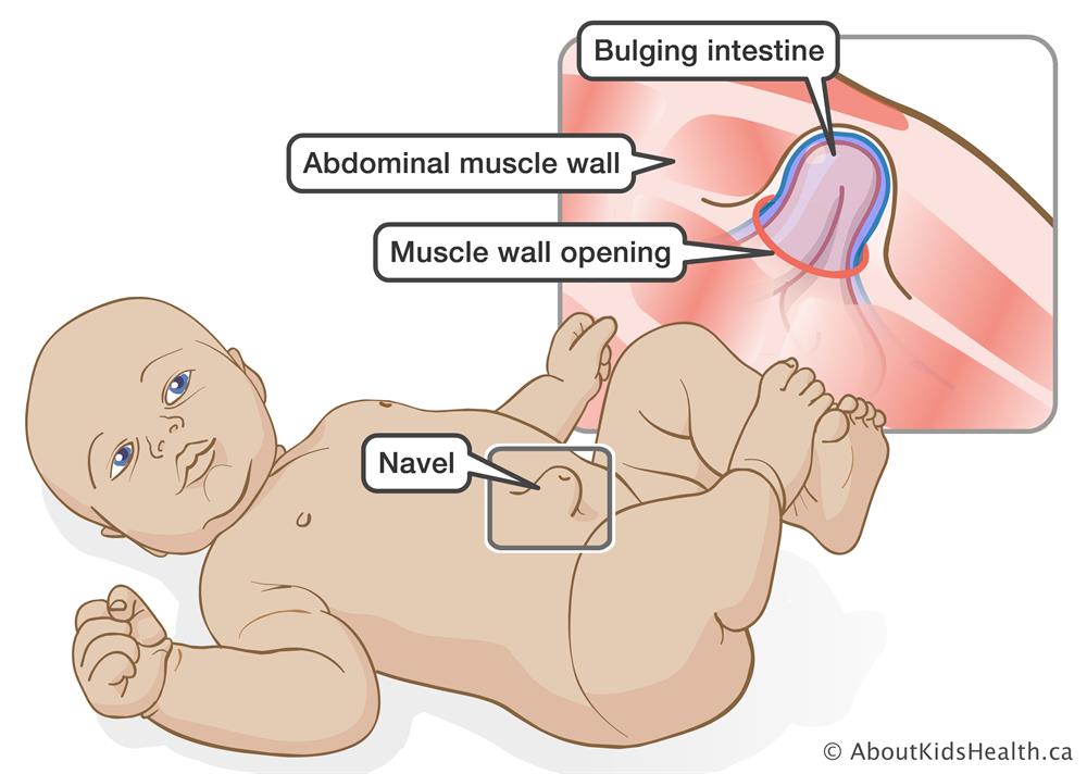 6 Jenis Simptom Sakit Perut Pada Bayi