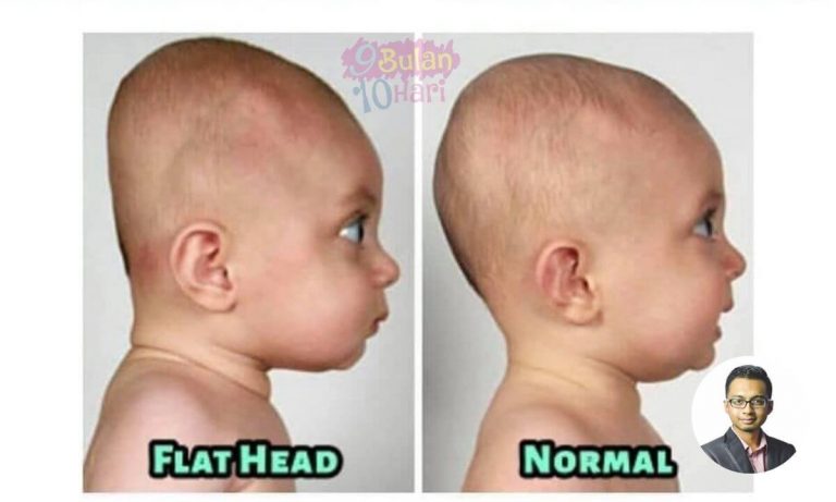 Bahagian Belakang Kepala Bayi Meleper Normal Ke? Ini 3 Jenis Aktiviti Untuk Kurangkan “Flat Head Syndrome”